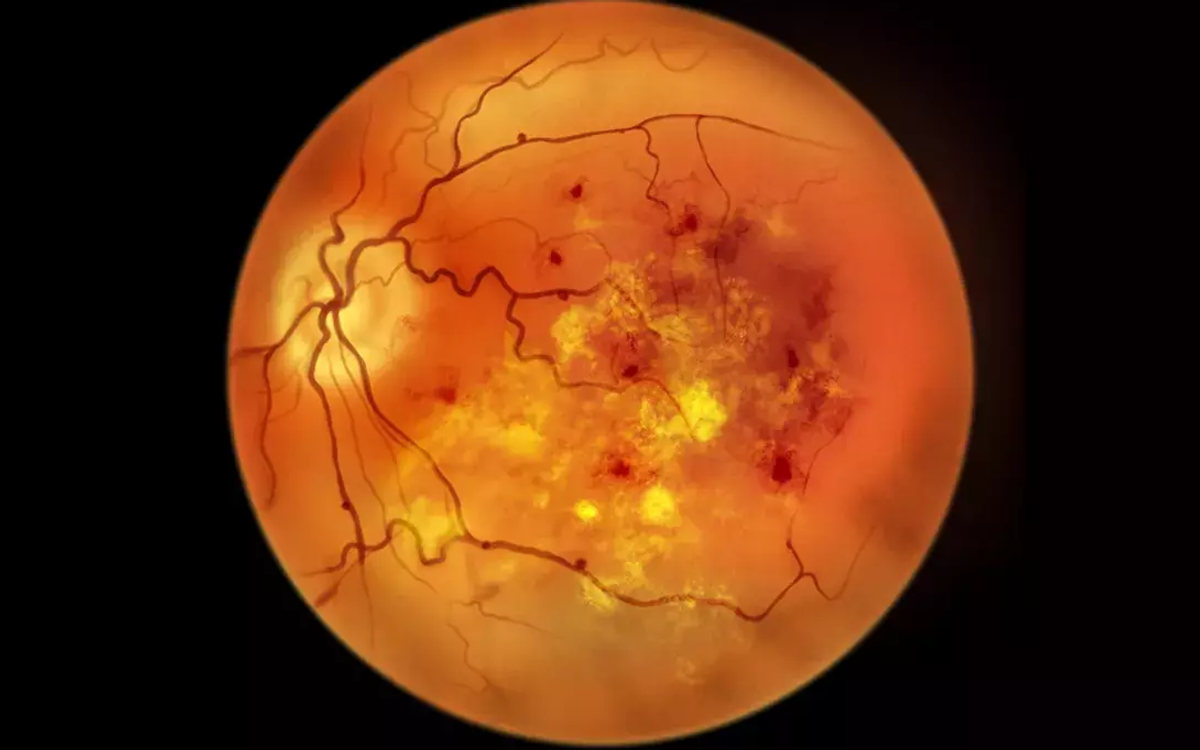 Retinografia de paciente com retinopatia diabética