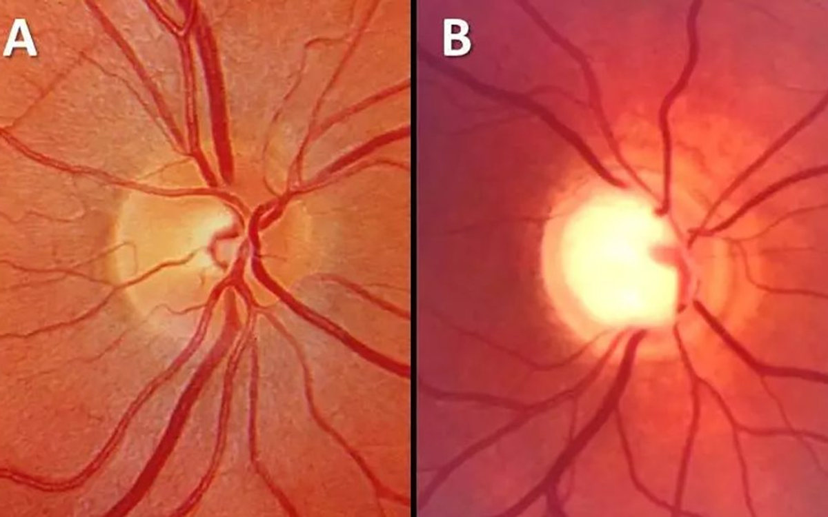 Comparação entre nervo óptico saudável e nervo com glaucoma