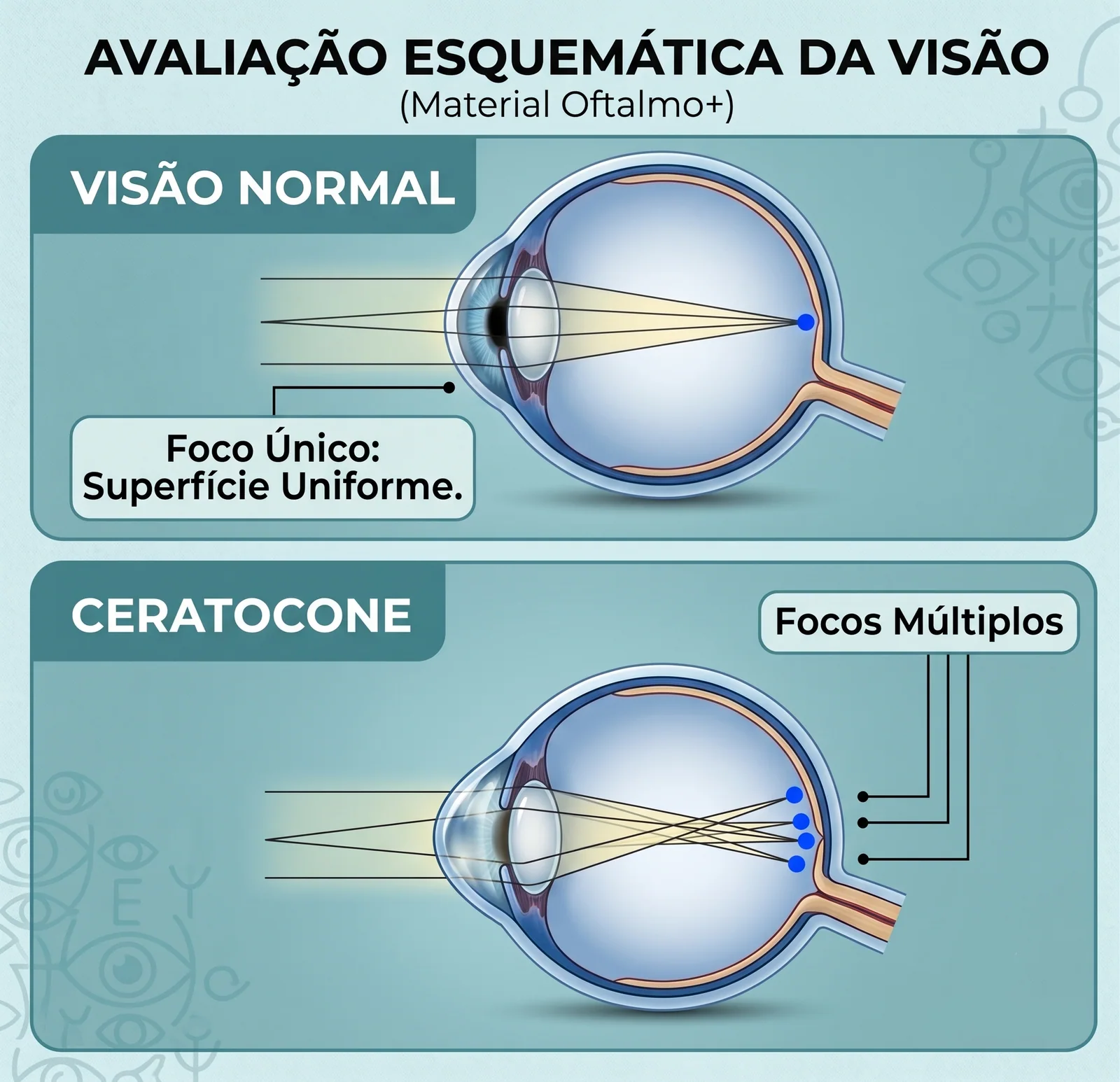 Comparação entre o foco da visão normal e os múltiplos focos provocados pelo ceratocone