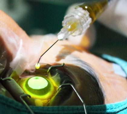 Aplicação de riboflavina durante procedimento de crosslinking corneano