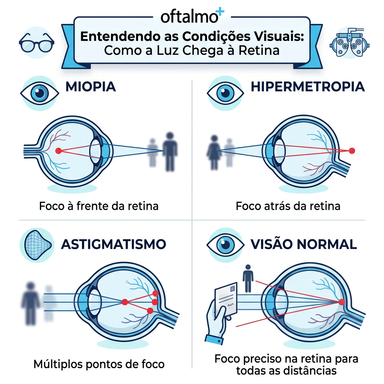 Diagrama mostrando como a luz chega à retina na miopia, hipermetropia, astigmatismo e visão normal