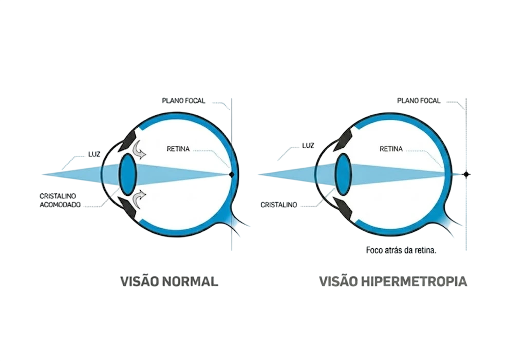 Comparação óptica entre a visão normal e a hipermetropia, mostrando o foco atrás da retina